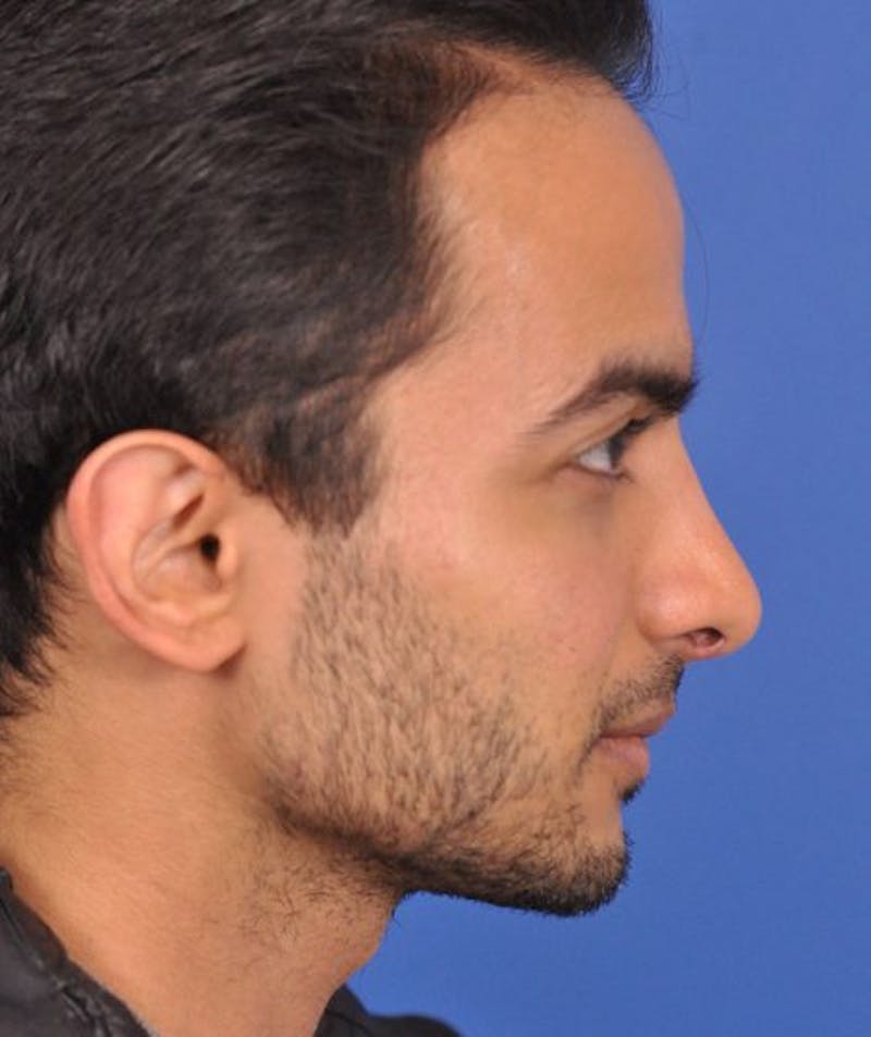 right side-after