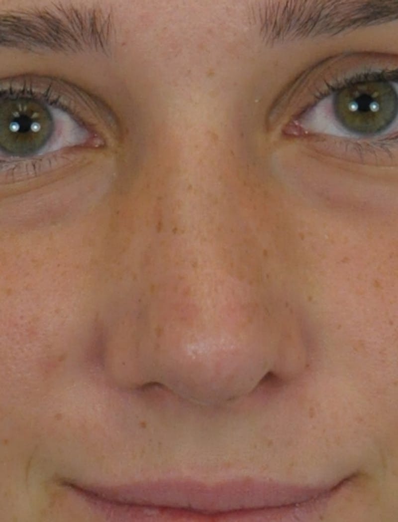 front-after