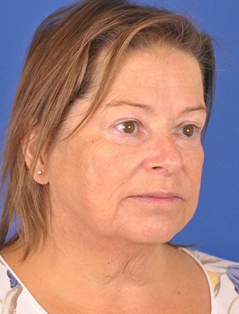 right front-after