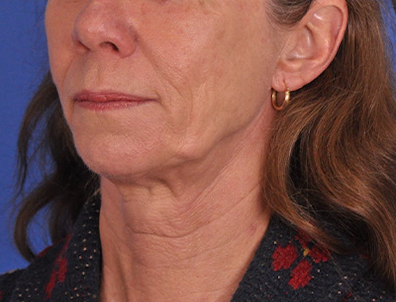 left front-before