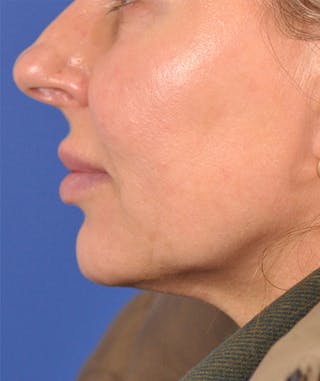left side-after