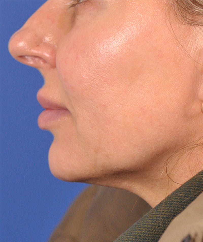 left side-after