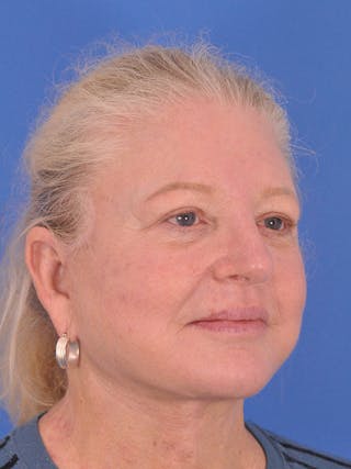 Facelift Before & After Gallery - Patient 165534110 - Image 4