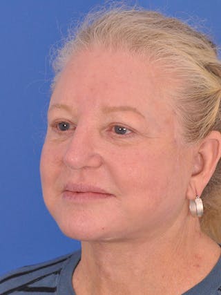 Facelift Before & After Gallery - Patient 165534110 - Image 8