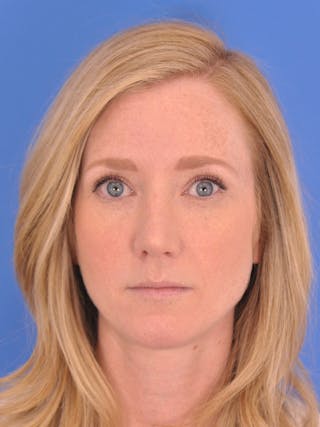 Rhinoplasty Before & After Gallery - Patient 166724988 - Image 4