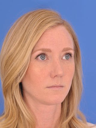 Rhinoplasty Before & After Gallery - Patient 166724988 - Image 6