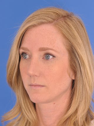 Rhinoplasty Before & After Gallery - Patient 166724988 - Image 8