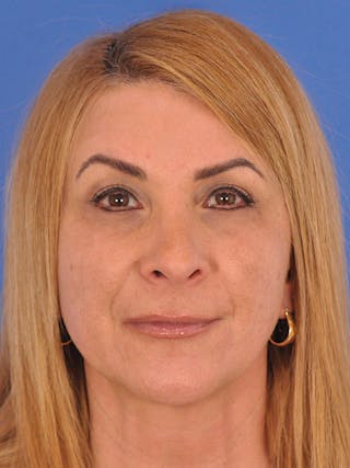 Rhinoplasty Before & After Gallery - Patient 166724987 - Image 4