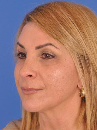 Rhinoplasty Before & After Gallery - Patient 166724987 - Image 8