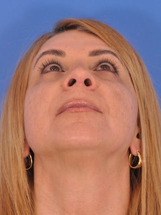 Rhinoplasty Before & After Gallery - Patient 166724987 - Image 12
