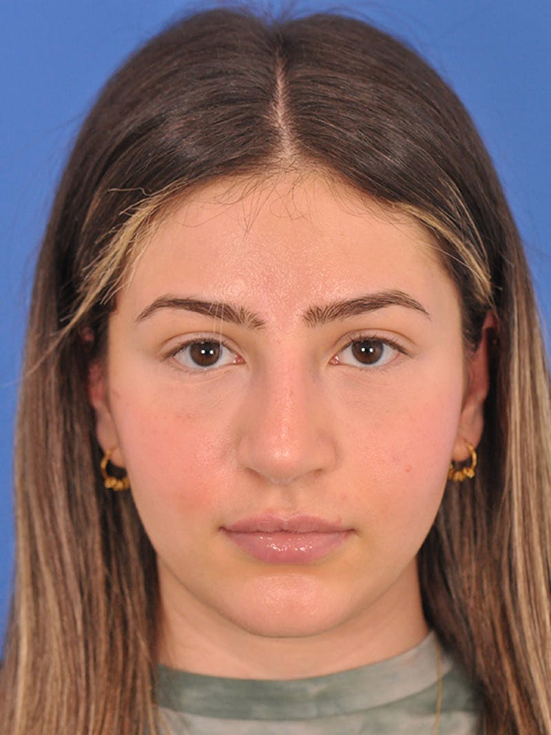 Rhinoplasty Before & After Gallery - Patient 166725000 - Image 4