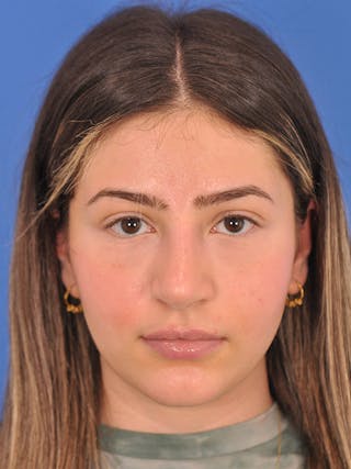 Rhinoplasty Before & After Gallery - Patient 166725000 - Image 4