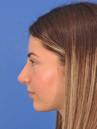 Rhinoplasty Before & After Gallery - Patient 166725000 - Image 10