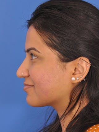 CO2RE Laser Before & After Gallery - Patient 180861943 - Image 10