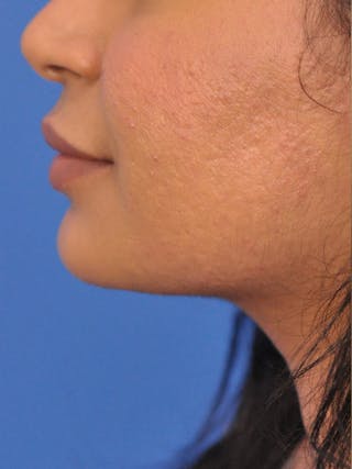 CO2RE Laser Before & After Gallery - Patient 180861986 - Image 4