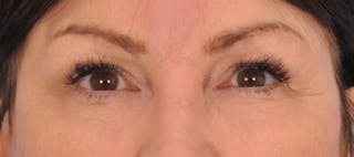 Brow Lift Before & After Gallery - Patient 180861999 - Image 2