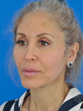Facelift Before & After Gallery - Patient 180862777 - Image 4