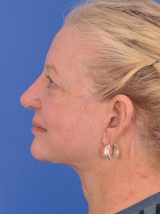 Facelift Before & After Gallery - Patient 180863107 - Image 10