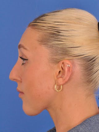 Otoplasty Before & After Gallery - Patient 180863296 - Image 6