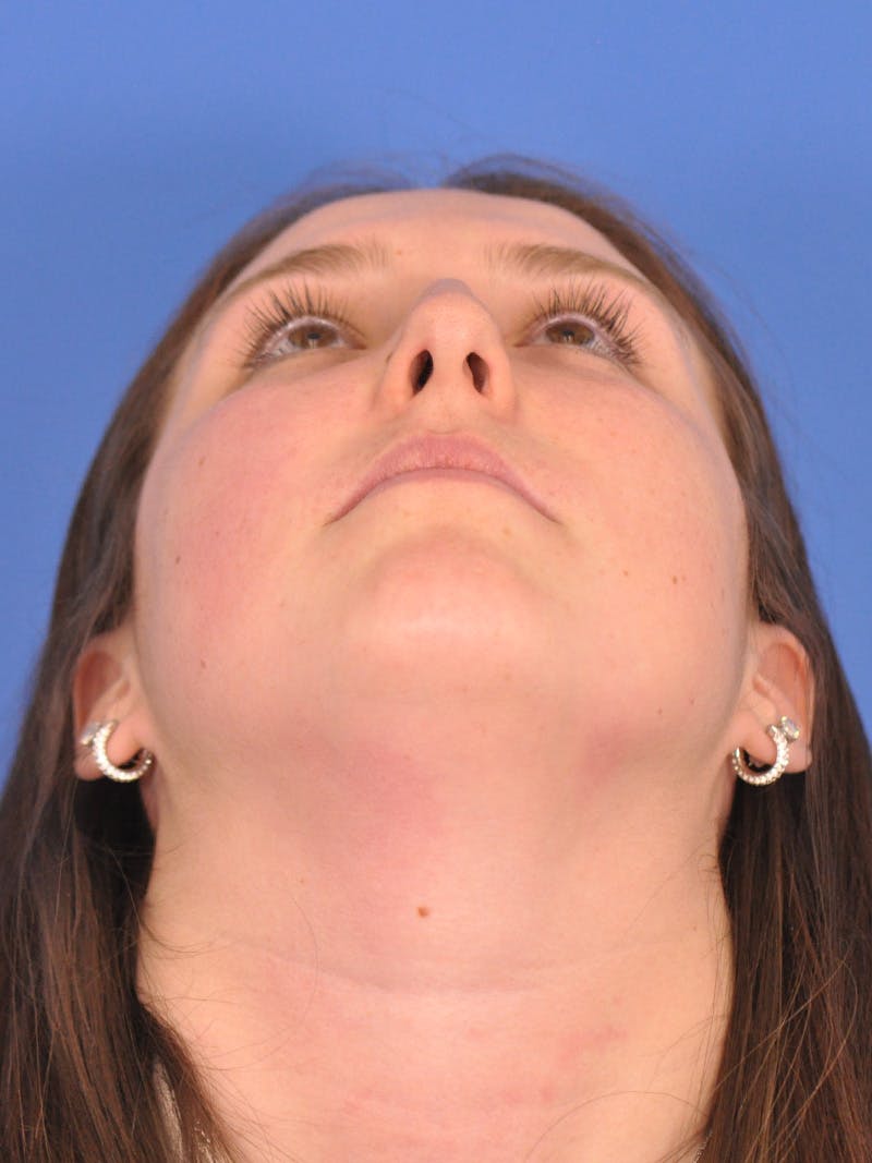 Rhinoplasty Before & After Gallery - Patient 180863337 - Image 11