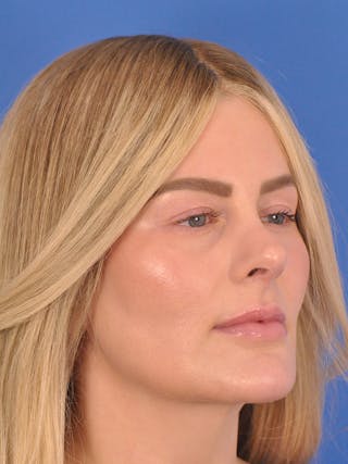 Rhinoplasty Before & After Gallery - Patient 180863483 - Image 6