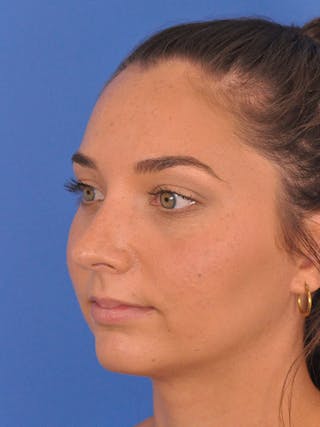 Rhinoplasty Before & After Gallery - Patient 180863822 - Image 8