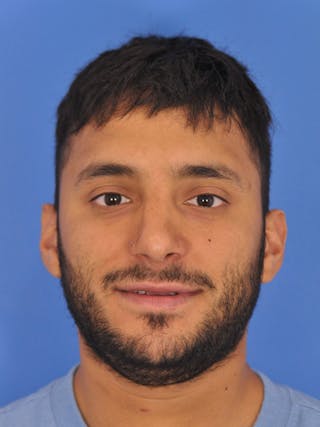 Rhinoplasty Before & After Gallery - Patient 180863863 - Image 4