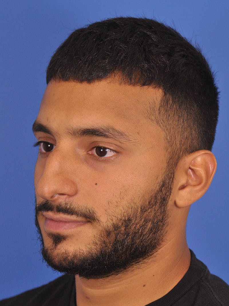 Rhinoplasty Before & After Gallery - Patient 180863863 - Image 7