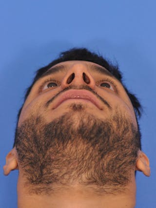 Rhinoplasty Before & After Gallery - Patient 180863863 - Image 10