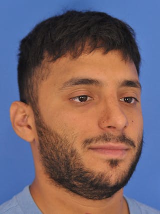 Rhinoplasty Before & After Gallery - Patient 180863863 - Image 6