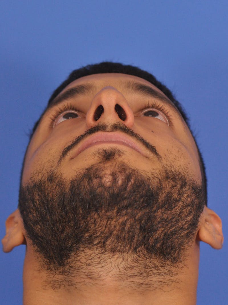 Rhinoplasty Before & After Gallery - Patient 180863863 - Image 9