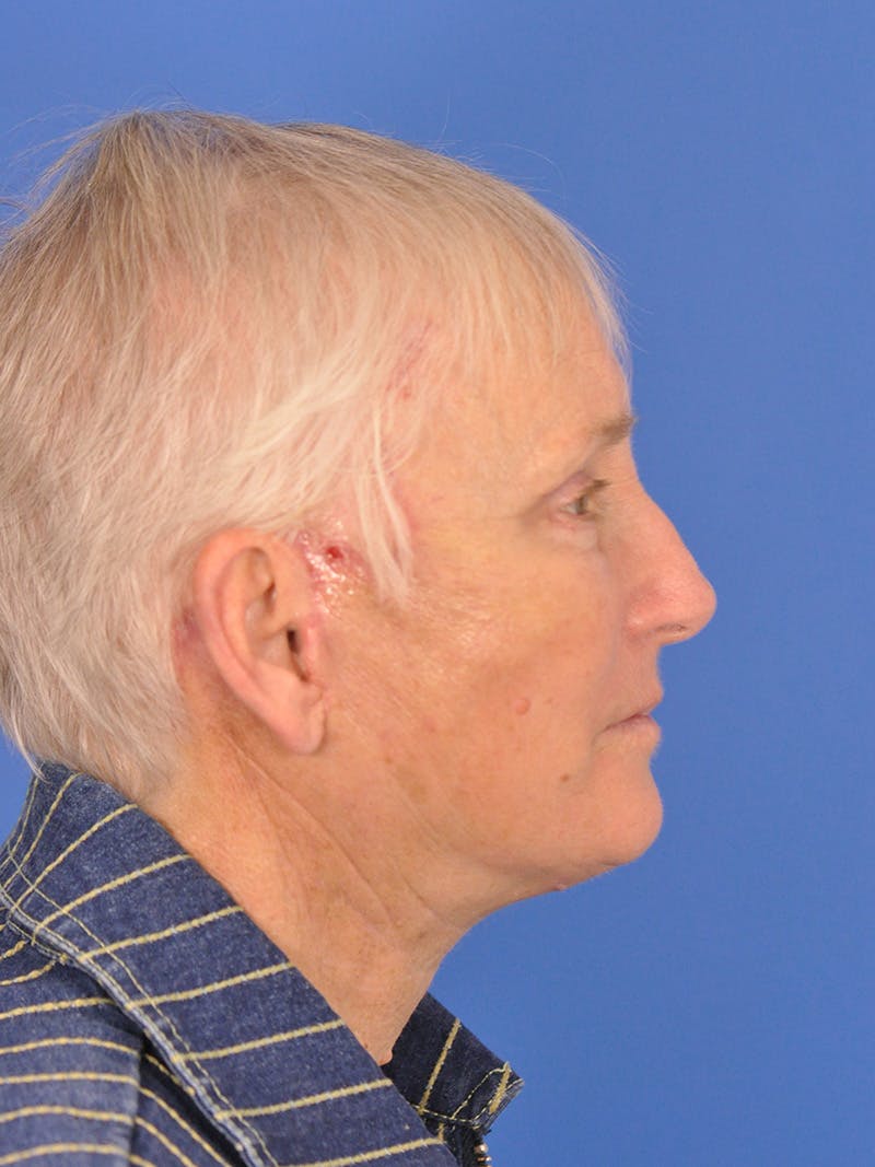 Brow Lift Before & After Gallery - Patient 180863867 - Image 5