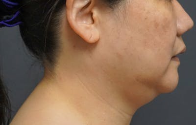 Neck Liposuction Before & After Gallery - Patient 119648 - Image 1