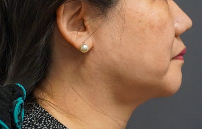 Neck Liposuction Before & After Gallery - Patient 119648 - Image 2