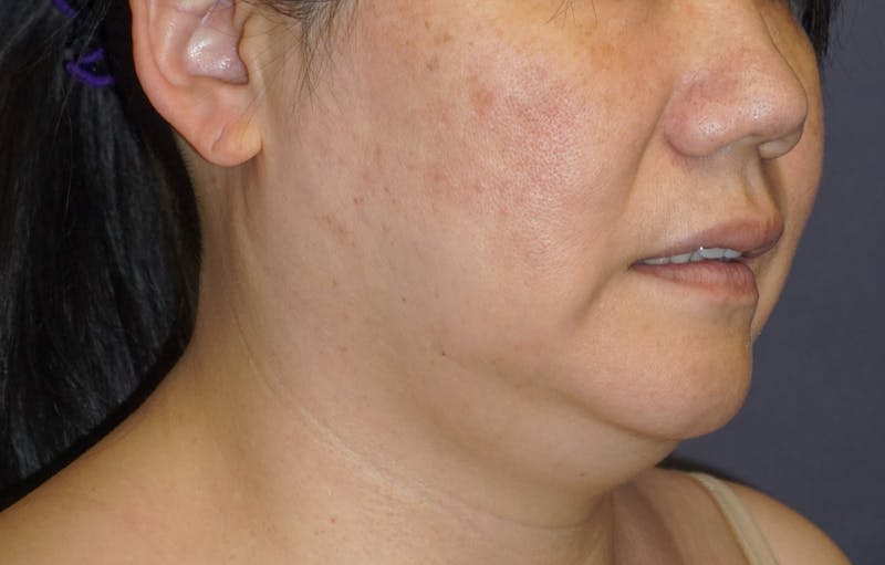 Neck Liposuction Before & After Gallery - Patient 119648 - Image 3