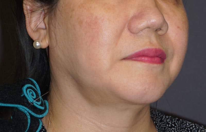 Neck Liposuction Before & After Gallery - Patient 119648 - Image 4