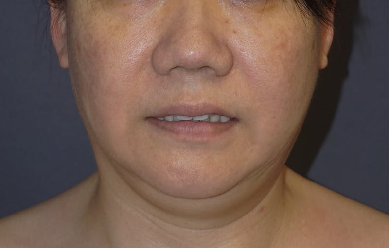 Neck Liposuction Before & After Gallery - Patient 119648 - Image 5