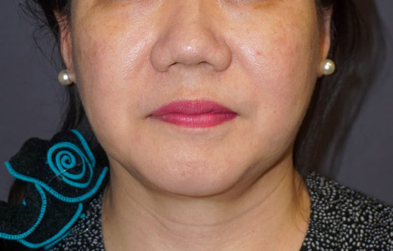 Neck Liposuction Before & After Gallery - Patient 119648 - Image 6