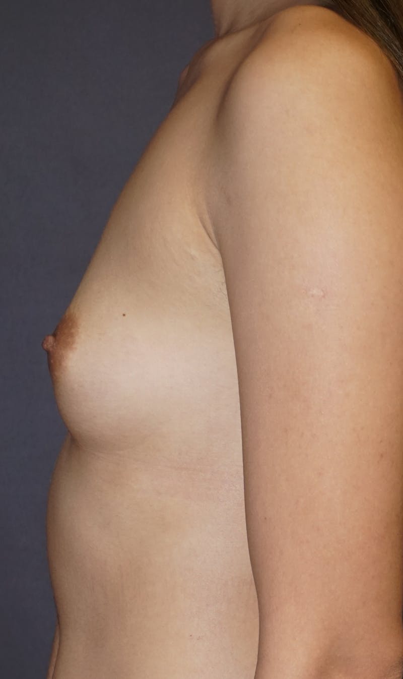 Breast Augmentation Before & After Gallery - Patient 247974 - Image 3