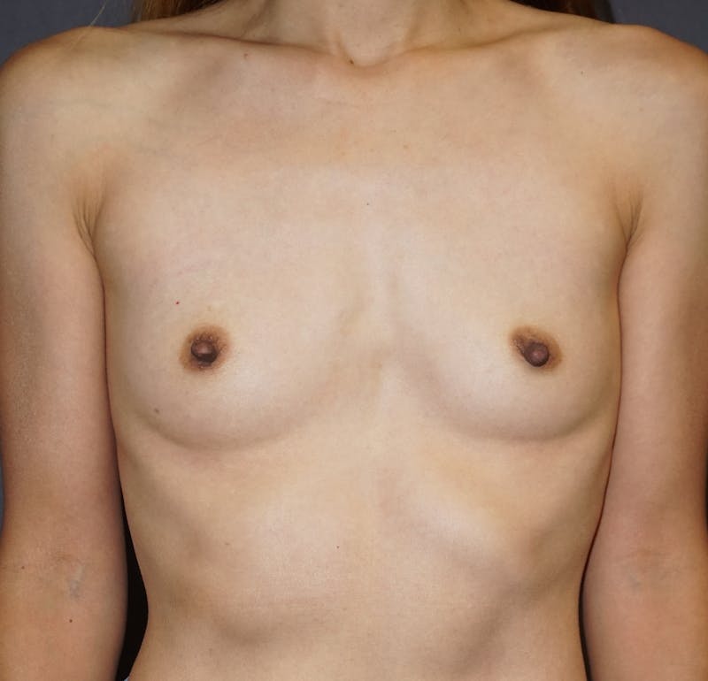 Breast Augmentation Before & After Gallery - Patient 153971 - Image 1