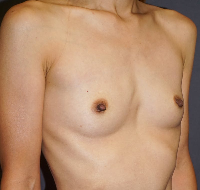 Breast Augmentation Before & After Gallery - Patient 153971 - Image 3