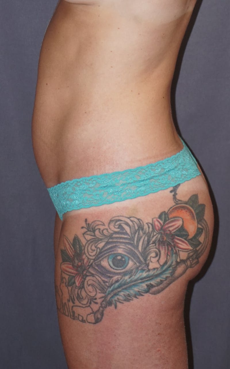 Liposuction Before & After Gallery - Patient 237943 - Image 5