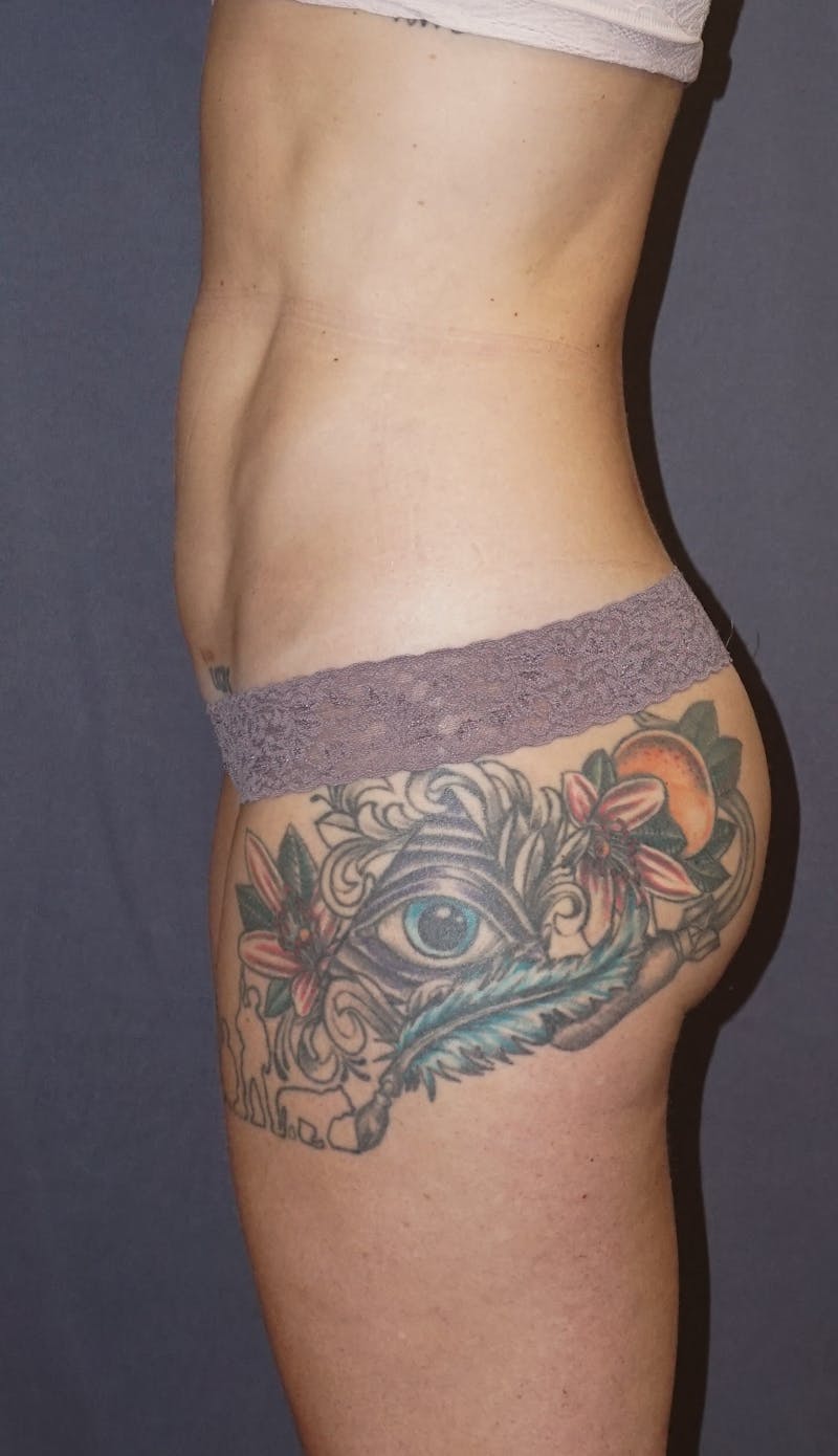 Liposuction Before & After Gallery - Patient 237943 - Image 6