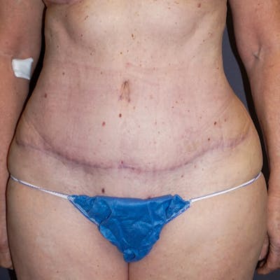 Tummy Tuck Before & After Gallery - Patient 176649 - Image 2