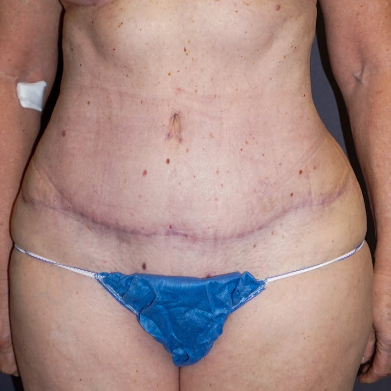 Tummy Tuck Before & After Gallery - Patient 176649 - Image 2