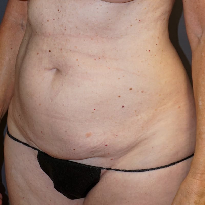 Tummy Tuck Before & After Gallery - Patient 176649 - Image 3