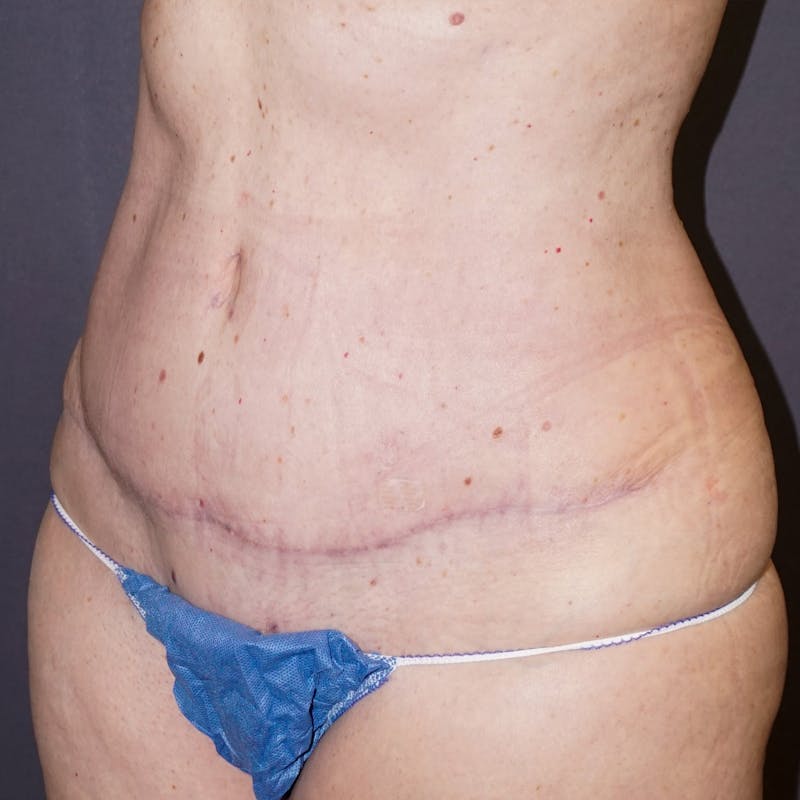 Tummy Tuck Before & After Gallery - Patient 176649 - Image 4