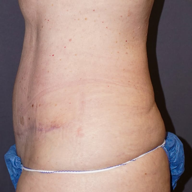 Tummy Tuck Before & After Gallery - Patient 176649 - Image 6