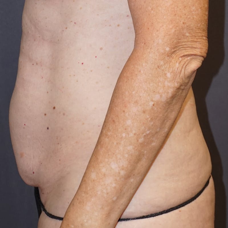 Tummy Tuck Before & After Gallery - Patient 176649 - Image 5