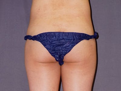 Brazilian Butt Lift Before & After Gallery - Patient 248673 - Image 1